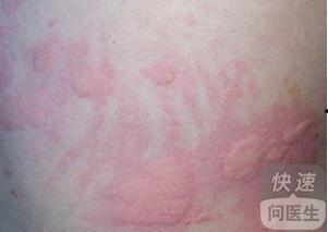 吃瓜过敏皮疹,揭秘过敏源与应对策略 第1张 吃瓜过敏皮疹,揭秘过敏源与应对策略 第1张